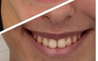 Apres la correction du sourire gingivale | Dr Vahedi | Paris