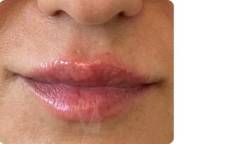 Apres acide hyaluronique lèvres | Dr Vahedi | Paris