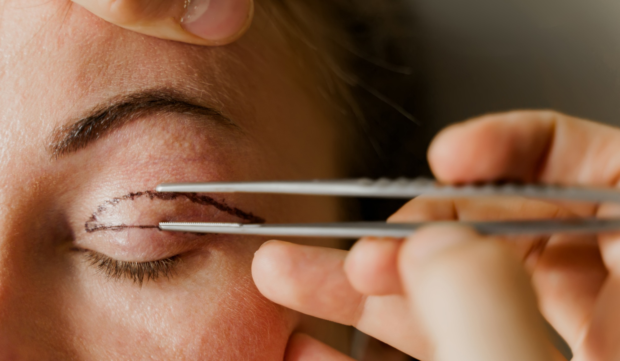 Deroulement blépharoplastie