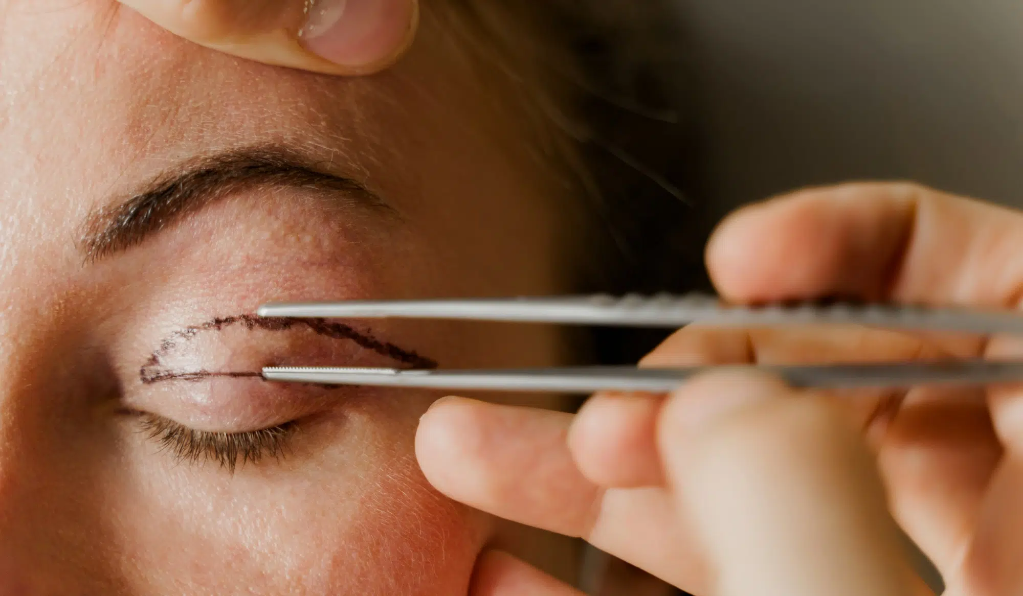 Deroulement blépharoplastie